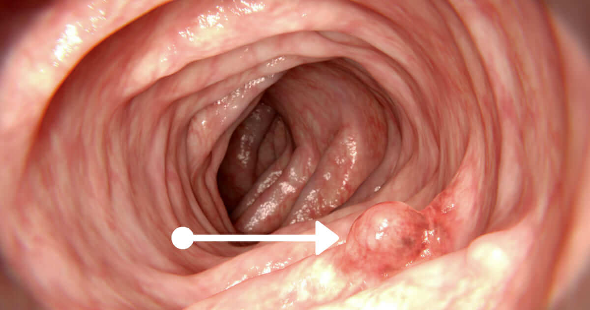 hpv cancer de colon